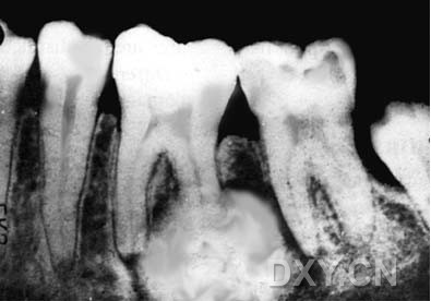 向四周发展,界限清楚) 大理石骨病(下颌骨有明显的骨化影像,恒牙埋伏)